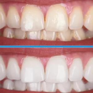 Clareamento Dental Profissional (1 Sessão)